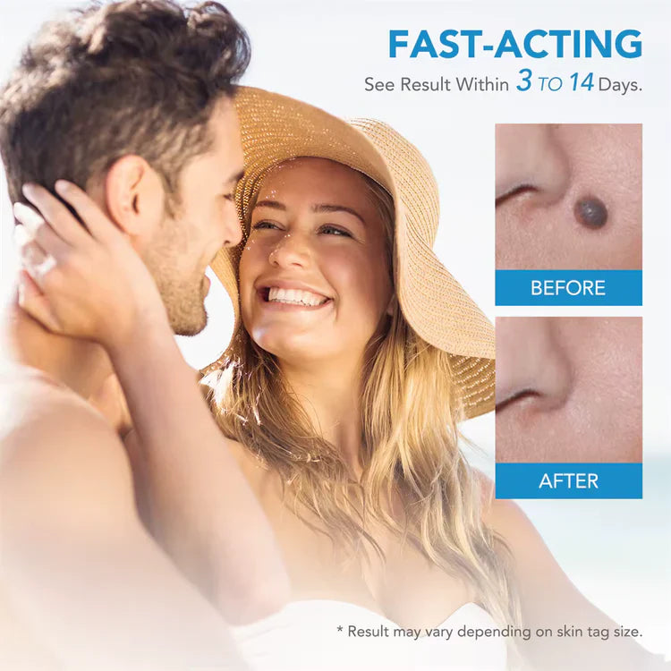 AutoSkin Tag Remover Kit - No More Skin Tags