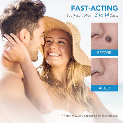 AutoSkin Tag Remover Kit - No More Skin Tags